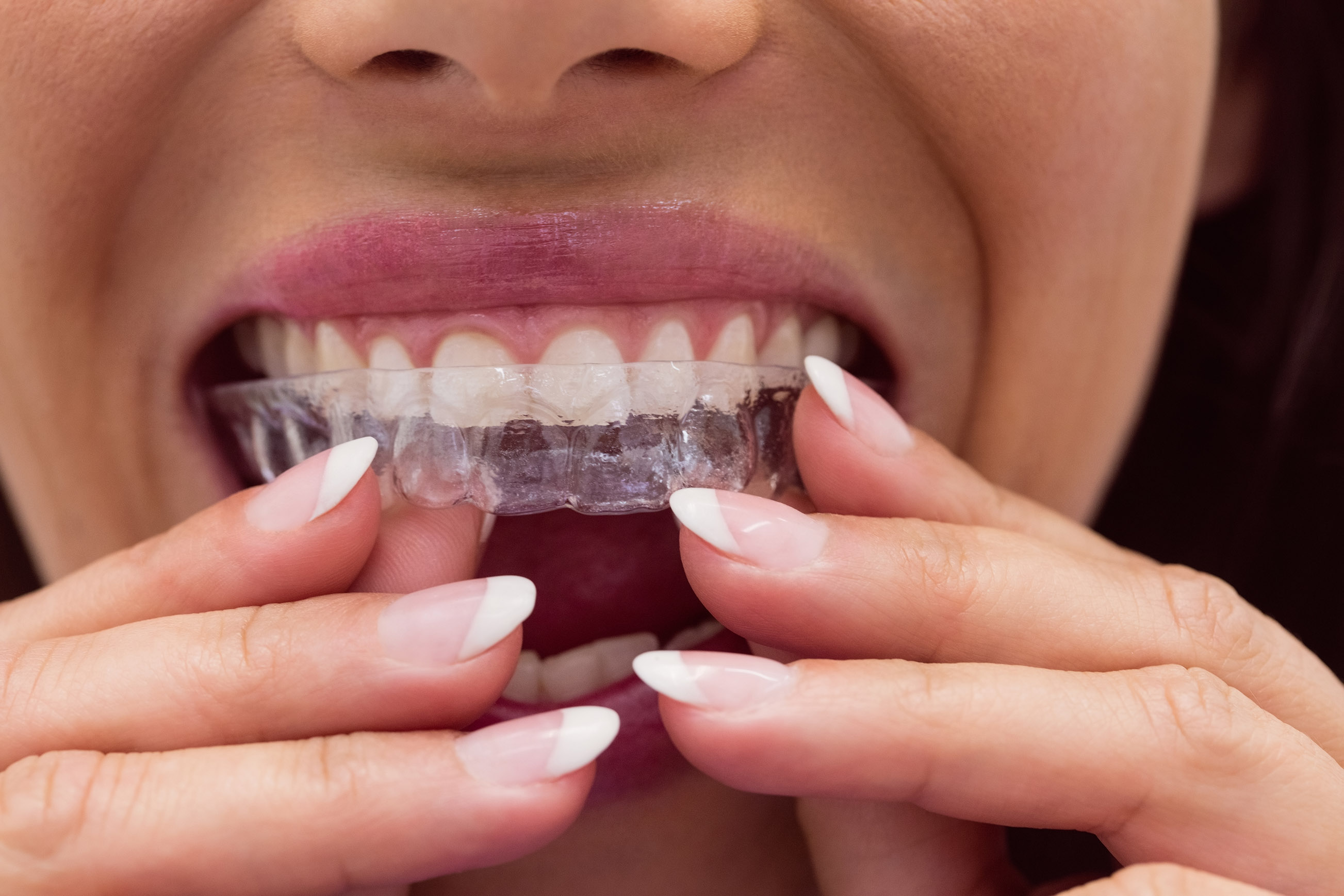 Gouttière dentaire : prix de l'orthodontie invisible