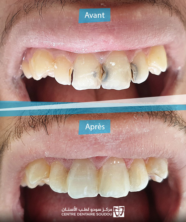 restaurations composites pour des dents antérieures cariées
